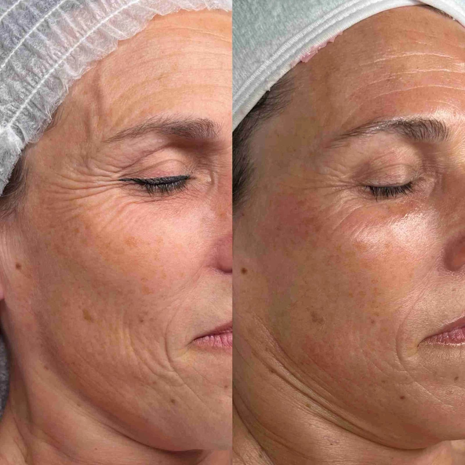 Antes y después Skin Reset — resultado 1