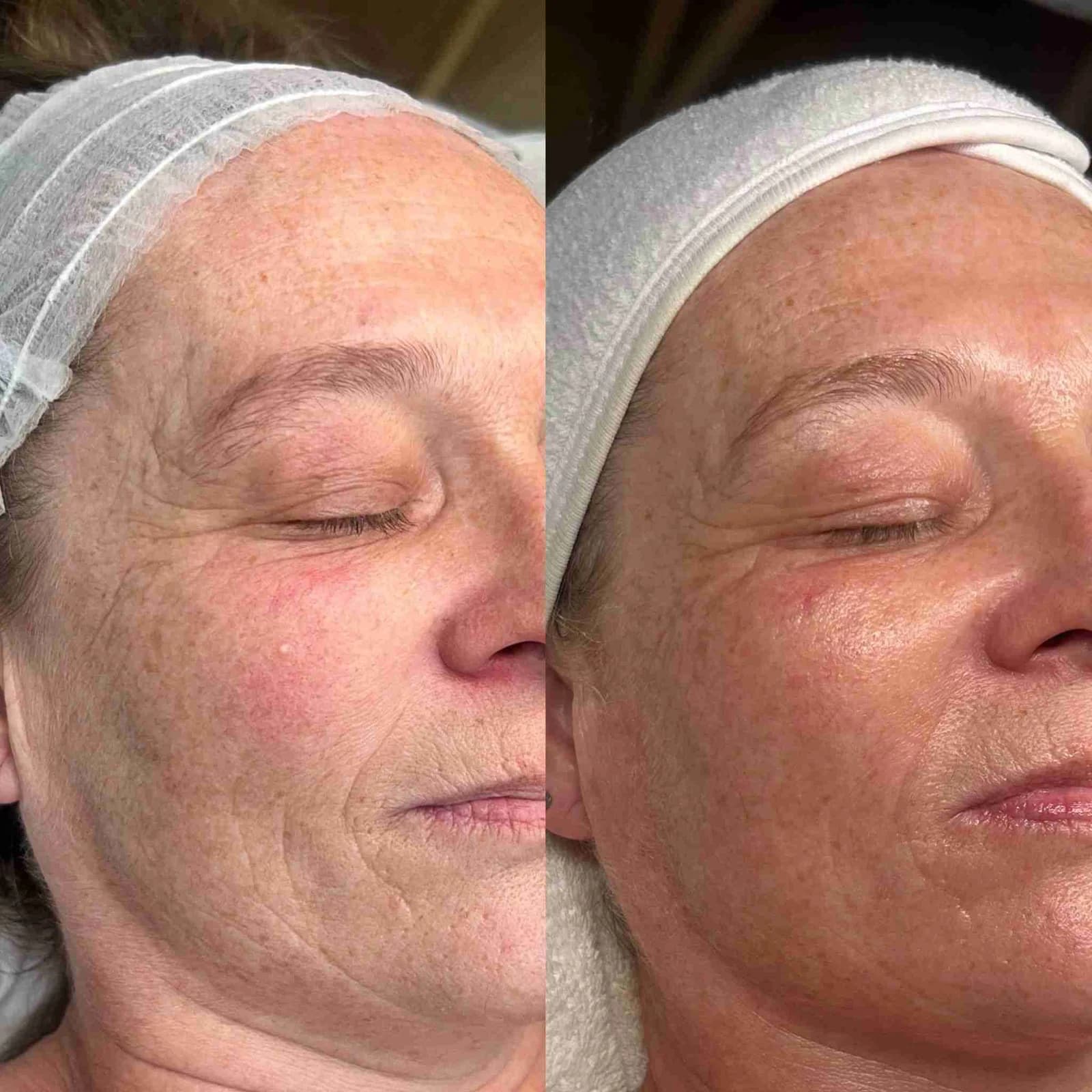 Antes y después Skin Reset — resultado 2